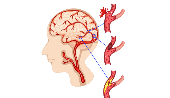 Tắc mạch máu não do một số thói quen sinh hoạt không tốt 