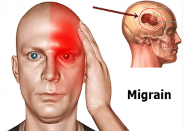 Đau nửa đầu là một trong những nguyên nhân gây đau vùng thái dương