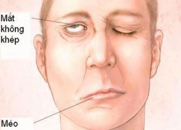 Nhiều người nhầm lãn cảm giác không cử động trong giấc ngủ với liệt nhược cơ