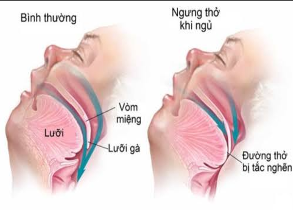 Ngưng thở khi ngủ là tình trạng đường thở bị tắc nghẽn thời gian ngắn khi ngủ
